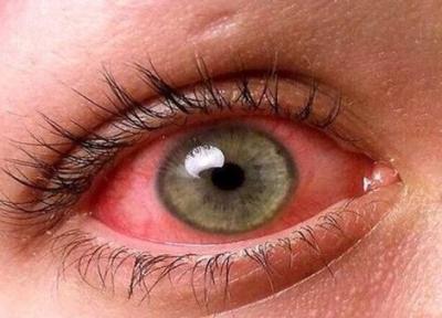 چرا چشم هایمان قرمز می شوند؟ ، 11 علت مهم قرمزی چشم را بدانید